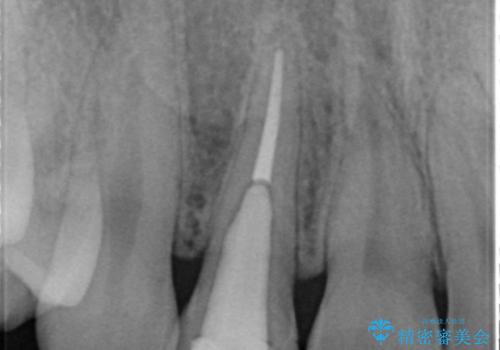 他院で入れたセラミッククラウンの色が気に入らない 20代男性の治療前