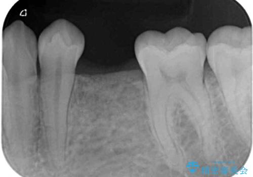 乳歯を抜いてインプラントに　咬み合わせ改善のインビザライン矯正の治療中