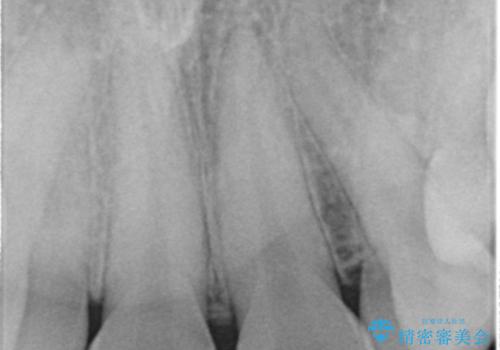 歯の位置異常 はやく治したい 矯正は嫌 20代女性の治療前