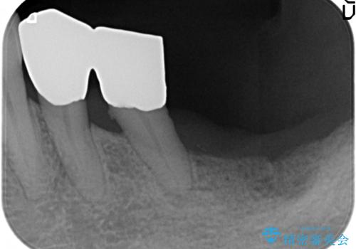 歯の動揺が気になる 低予算ではやく治したい 50代女性の治療前