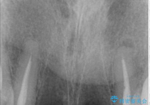 転んで前歯が2本ぬけた 自然なブリッジへ 60代男性の治療前