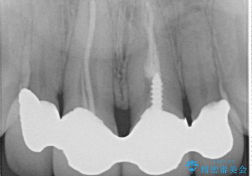 前歯のかぶせ物をオールセラミックへ 形を含めて理想の前歯への治療前