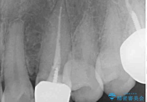 保険診療の変色したクラウン　前歯の審美歯科治療の治療前