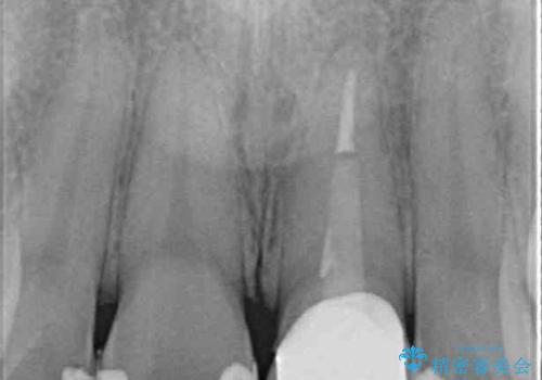 出っ歯に仕上がってしまった前歯 セラミッククラウンの作り替えの治療前