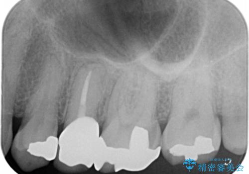 歯ぐきを押すと痛い　神経が死んでいる歯の治療　40代女性の治療後