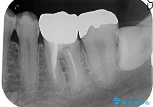 金属を白くしたい、セラミックへの治療前