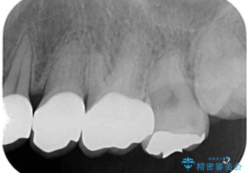 Kポップアイドルのような歯にしたい! 20代男性の治療後