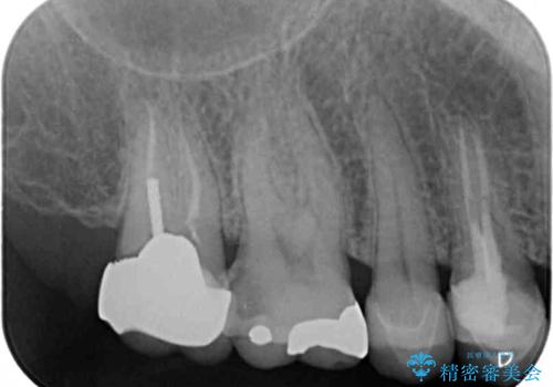 強い咬み合わせでむし歯が悪化　ゴールドインレーによるむし歯治療の治療前
