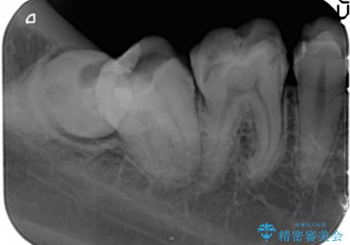 憧れの芸能人のような白い歯に 30代男性の治療前