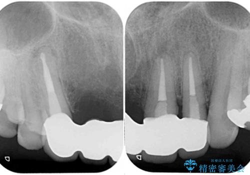 話しにくく見栄えの悪い前歯 オールセラミックブリッジの治療後