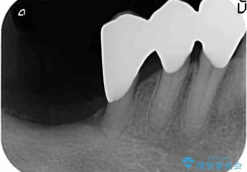 歯の動揺が気になる 低予算ではやく治したい 50代女性の治療後