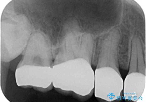 Kポップアイドルのような歯にしたい! 20代男性の治療後
