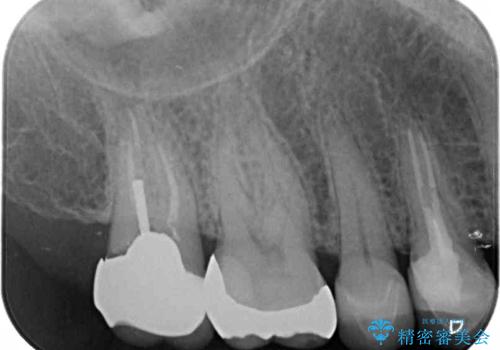 強い咬み合わせでむし歯が悪化 ゴールドインレーによるむし歯治療の治療後