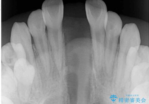 遠方から新幹線で通院 急速拡大装置とインビザラインによる矯正治療の治療中