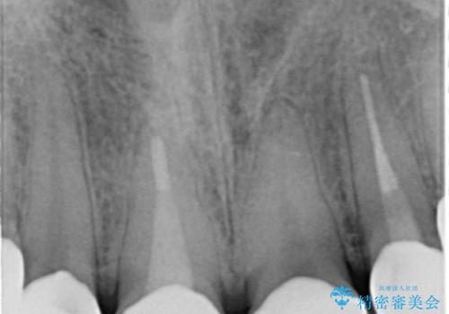憧れの芸能人のような白い歯に 30代男性の治療後
