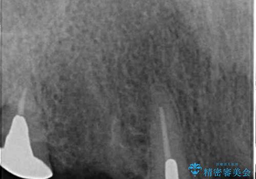 交通事故で前歯が折れた マグネットデンチャー 50代男性の治療後