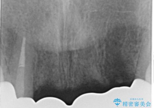 転んで前歯が2本ぬけた 自然なブリッジへ 60代男性の治療後