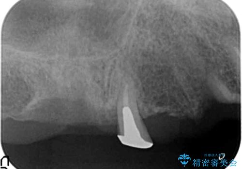 交通事故で前歯が折れた マグネットデンチャー 50代男性の治療後