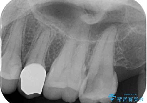 冷たいものがしみる 神経組織の一部を除去した虫歯治療の治療前