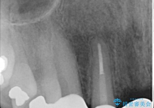 転んで前歯が2本ぬけた 自然なブリッジへ 60代男性の治療後
