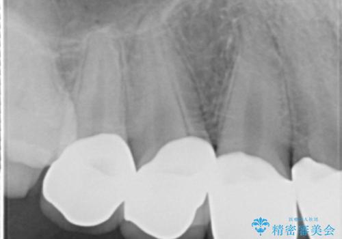 憧れの芸能人のような白い歯に 30代男性の治療後