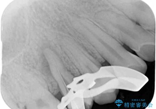 神経が死んで変色した歯 根管治療とオールセラミッククラウンの治療中