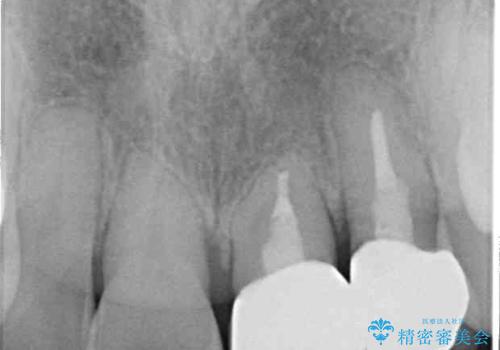 反対咬合で痛む前歯を改善 インビザラインによる矯正治療の治療後