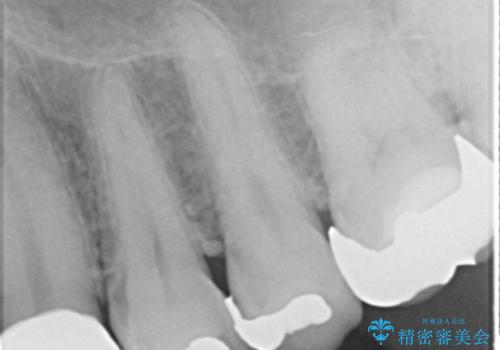 転んで前歯が2本ぬけた 自然なブリッジへ 60代男性の治療後
