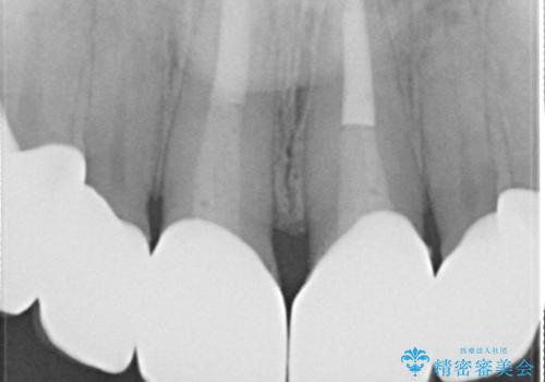 前歯のかぶせ物をオールセラミックへ 形を含めて理想の前歯への治療後