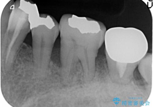 歯周病を治す 再生療法 50代男性の治療前