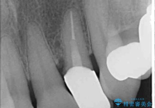 歯の動揺が気になる 低予算ではやく治したい 50代女性の治療後