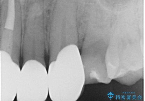 前歯のかぶせ物をオールセラミックへ　形を含めて理想の前歯への治療後