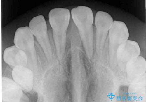 遠方から新幹線で通院 急速拡大装置とインビザラインによる矯正治療の治療後