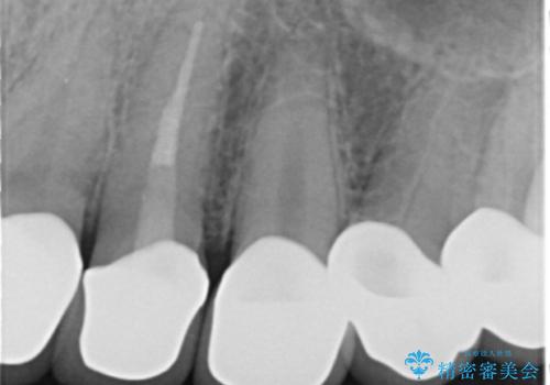 憧れの芸能人のような白い歯に 30代男性の治療後
