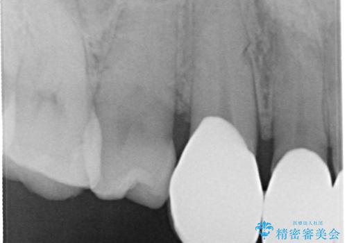 前歯のかぶせ物をオールセラミックへ 形を含めて理想の前歯への治療前