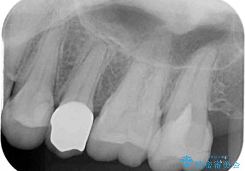 冷たいものがしみる 神経組織の一部を除去した虫歯治療の治療後