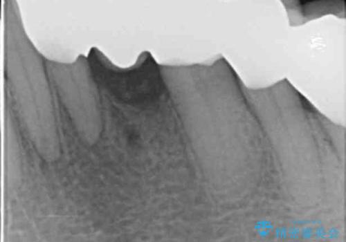 歯の動揺が気になる 低予算ではやく治したい 50代女性の治療後