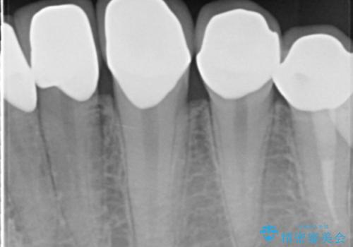 憧れの芸能人のような白い歯に 30代男性の治療後