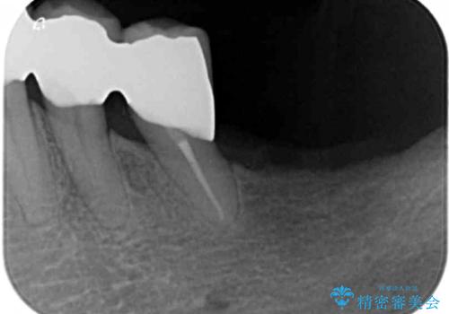 歯の動揺が気になる 低予算ではやく治したい 50代女性の治療後