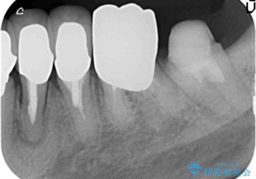 少ない残存歯質　抜歯ギリギリの歯を残すの治療前