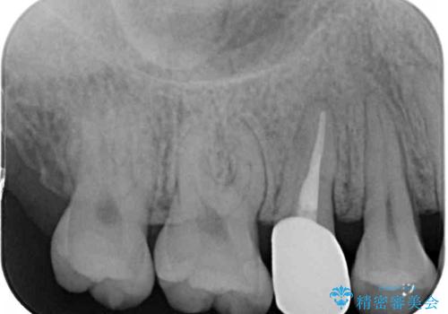 神経が死んで変色した歯 根管治療とオールセラミッククラウンの治療後