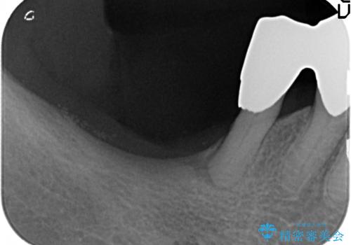歯の動揺が気になる 低予算ではやく治したい 50代女性の治療前