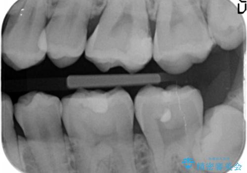 奥歯にフロスを通すと臭い 30代女性の治療前