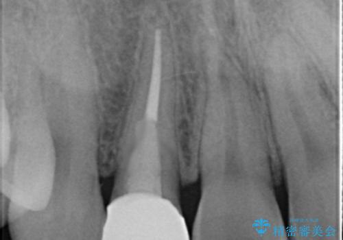 他院で入れたセラミッククラウンの色が気に入らない 20代男性の治療後
