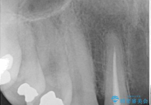 転んで前歯が2本ぬけた 自然なブリッジへ 60代男性の治療前