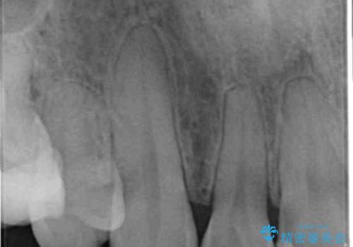 Kポップアイドルのような歯にしたい! 20代男性の治療前