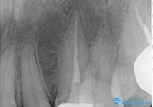 保険診療の変色したクラウン 前歯の審美歯科治療の治療後