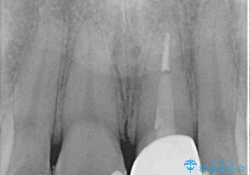 出っ歯に仕上がってしまった前歯 セラミッククラウンの作り替えの治療後
