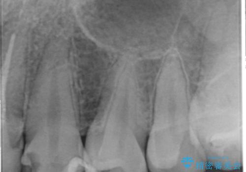 憧れの芸能人のような白い歯に 30代男性の治療前