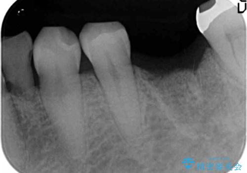 強い噛み合わせによる歯牙破折後のインプラント治療の治療前